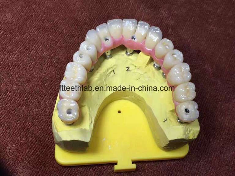 Full Arch Zirconium Implant Bridge From China Dental Lab